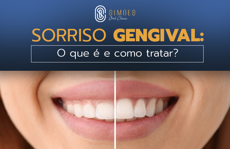 Sorriso Gengival: O que é e como tratar?