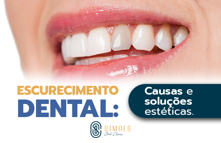 Escurecimento Dental: Causas e soluções estéticas